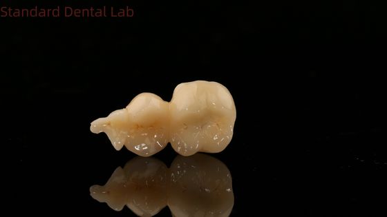 La couronne dentaire numérique complète en zirconium avec modèle d'impression 3D