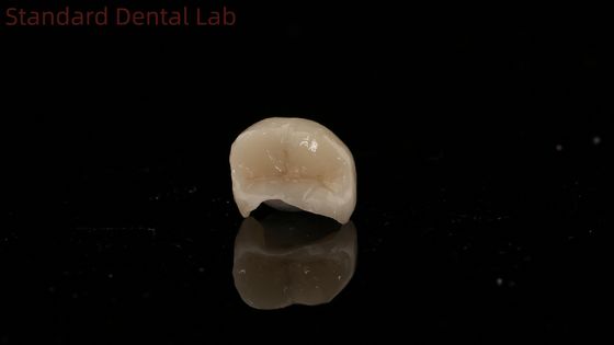 Couronne translucide dentaire en zirconium incrustée couronne onlay pour restaurer la forme naturelle de la cavité