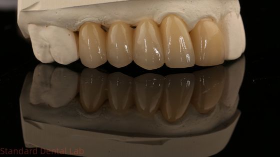 Noritake Porcelaine à contour complet Couronne en zirconium haute esthétique naturelle sur mesure Pont dentaire en zirconium