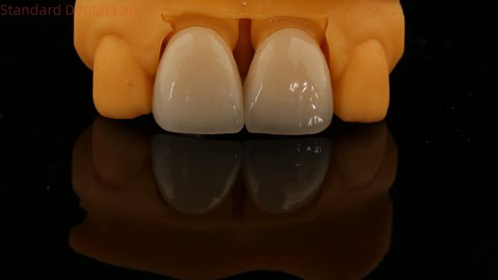 5 ans de garantie Contour complet couronne de zirconium personnalisée Vita teinte haute esthétique pont dentaire naturel