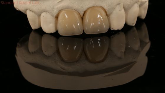 Une couronne en zirconium et un pont dentaire naturel esthétique 5 ans de garantie