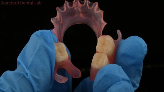 Dentiste TCS Valplast Dentures partielles flexibles Nesbit Valplast Finition Chine Laboratoire dentaire Valplast Fermeture