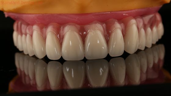 Implantation partielle en acrylique sur denture en titanium Bar denture complète