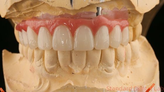 Bien ajusté, esthétique, précis, zirconium, porcelaine, couronne, porcelaine rose, avec teinte de blanchiment