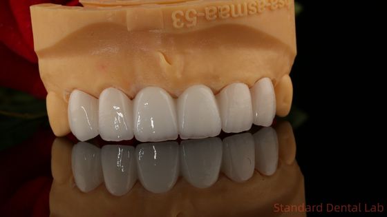 La couronne en zirconium translucide 3D PRO sans revêtement en porcelaine