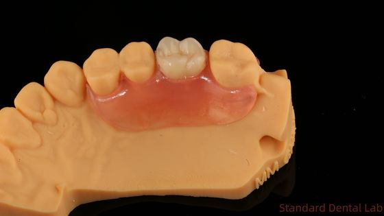 Dentiste TCS Valplast Dentures partielles flexibles Nesbit Valplast Finition Chine Laboratoire dentaire Valplast Fermeture