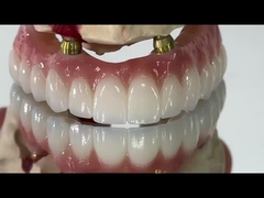 Dentistique tout sur X Implant PFM Couronne Titane Fixée Hybride Prothèse
