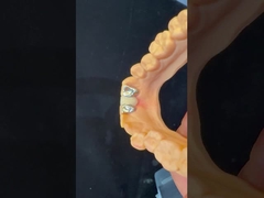 Dentistique PFM Maryland Bridge haute esthétique certifiée FDA