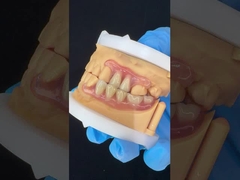 Modèle d'impression 3D Dentistique haute esthétique TCS Valplast Flexible Prothèses partielles Laboratoire dentaire