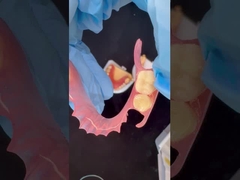 Modèle d'impression 3D Dentistique haute esthétique TCS Valplast Flexible Prothèses partielles Laboratoire dentaire