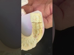 Dentiste numérique couronne de zirconium complète avec modèle d'impression 3D SDL Dental Lab bon prix